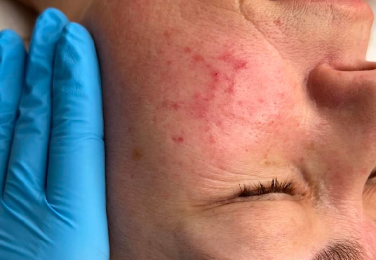 Demodex erkutės