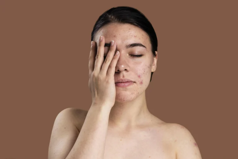 Kaip atsikratyti spuogų dermatologų patarimai ir veiksmingi metodai