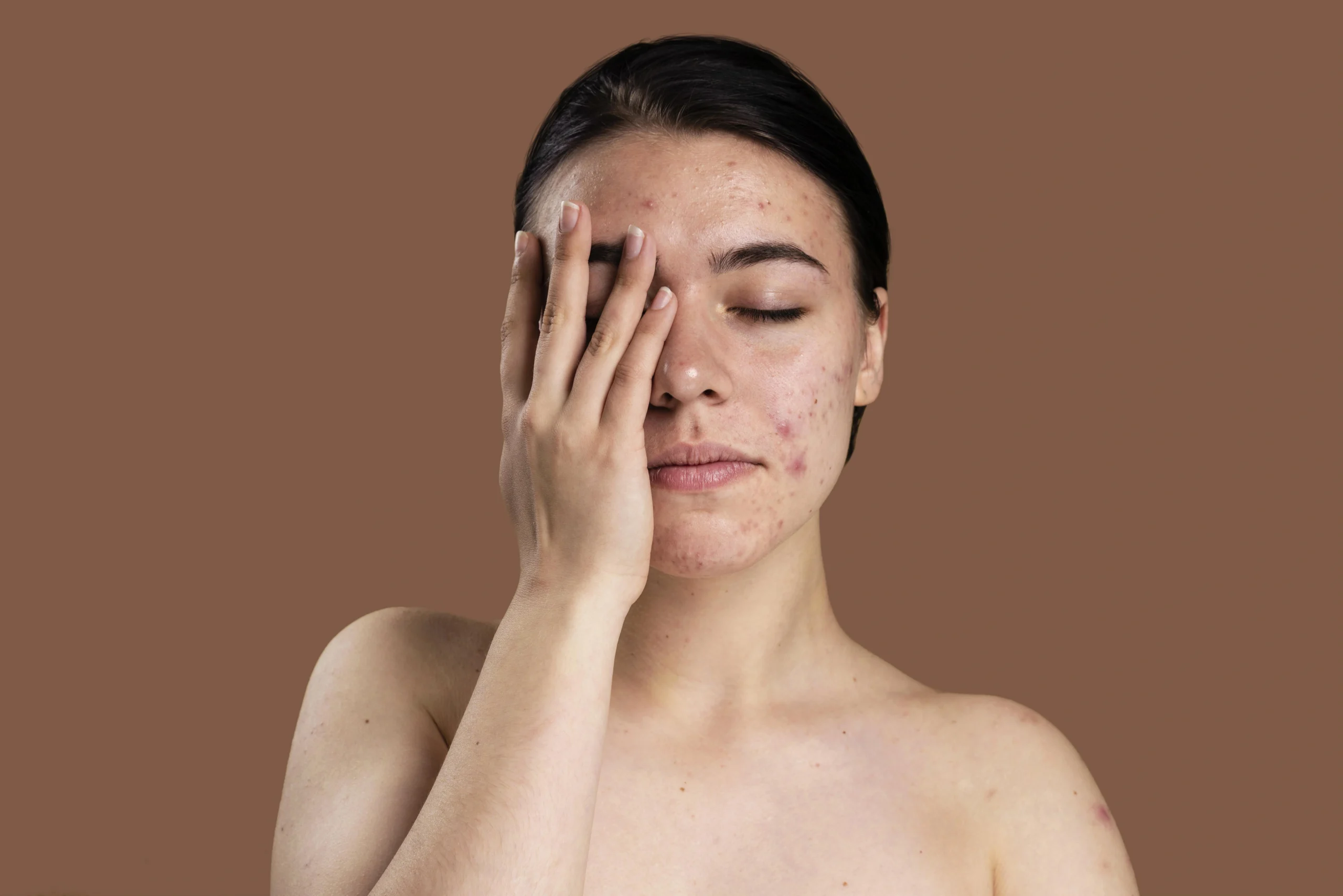 Kaip atsikratyti spuogų dermatologų patarimai ir veiksmingi metodai
